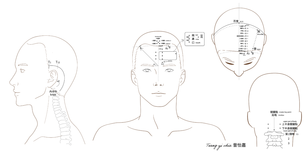 特種針灸介紹:莊氏頭針 1 image